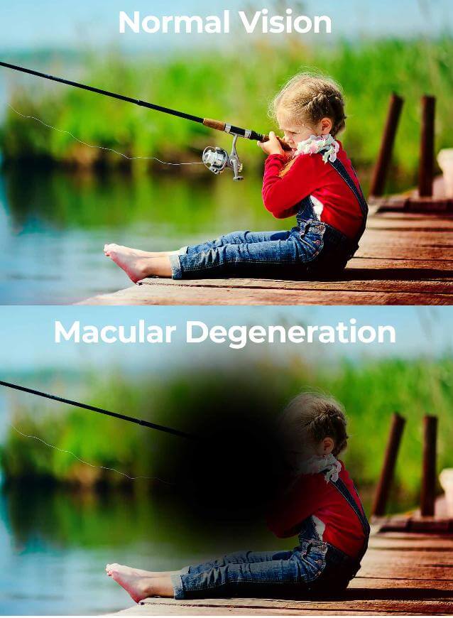 A child fishing, seen with and without macular degeneration